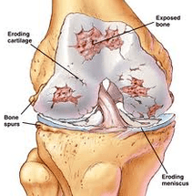 The mechanism of the development of arthrosis
